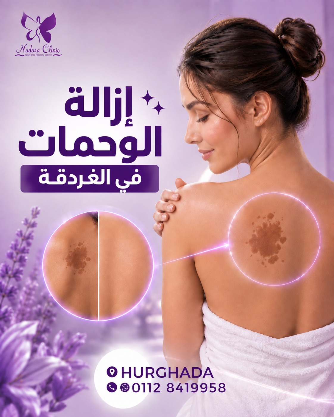 إزالة الوحمات في الغردقة